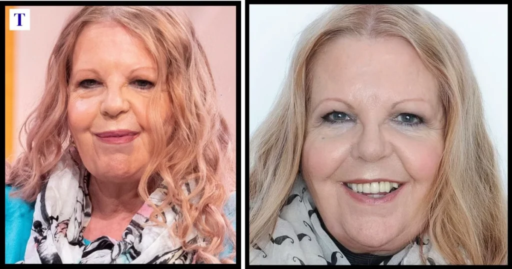 Sally Thomsett Face Illness